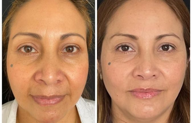 Rinoplastia Caso 35 Antes - Después