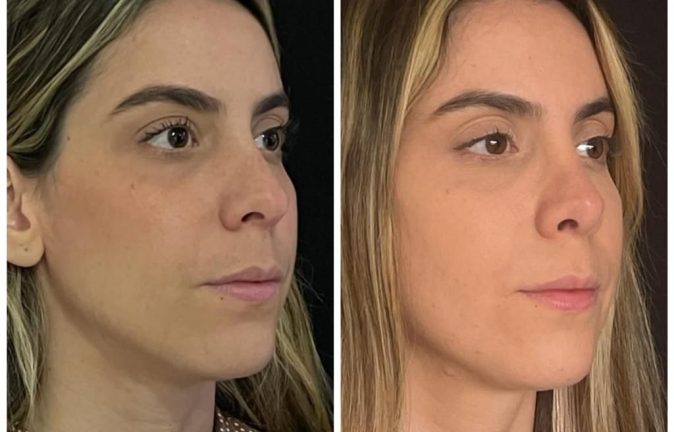 Rinoplastia Caso 36 Antes - Después 4