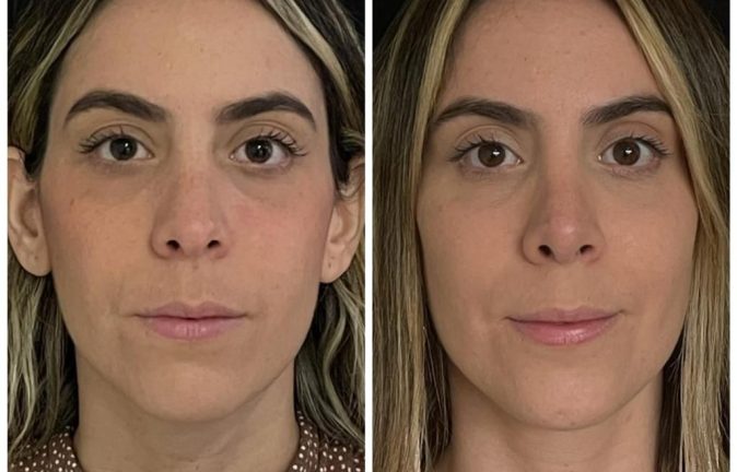 Rinoplastia Caso 36 Antes - Después