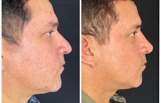 Rinoplastia Caso 37 Antes - Después 2