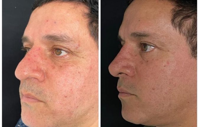 Rinoplastia Caso 37 Antes - Después 3