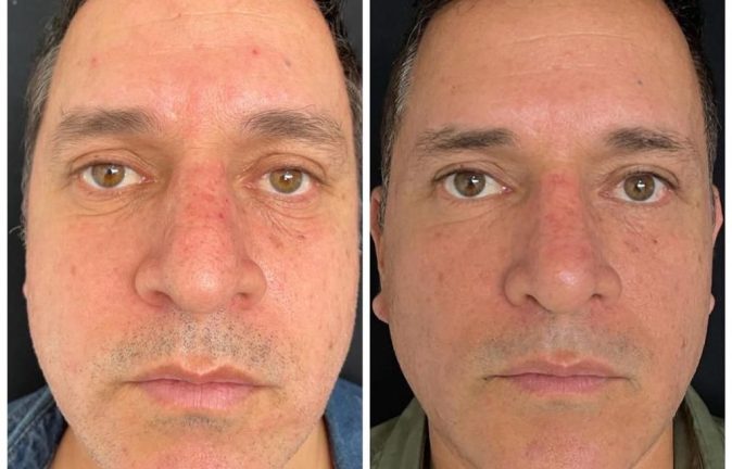 Rinoplastia Caso 37 Antes - Después