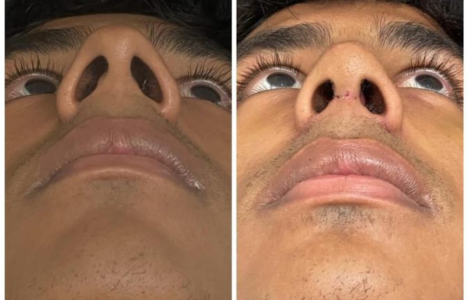 Rinoplastia Caso 38 Antes - Después 2