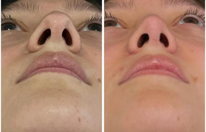 Rinoplastia Caso 39 Antes - Después 2