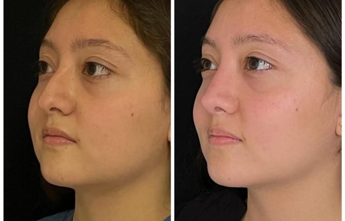 Rinoplastia Caso 39 Antes - Después 4