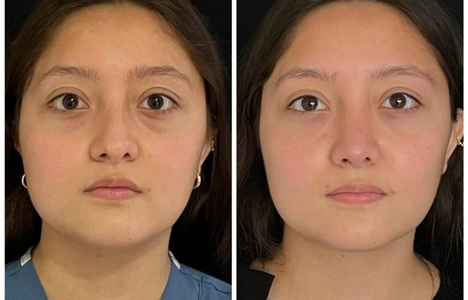 Rinoplastia Caso 39 Antes - Después