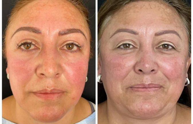 Rinoplastia Caso 40 Antes - Después