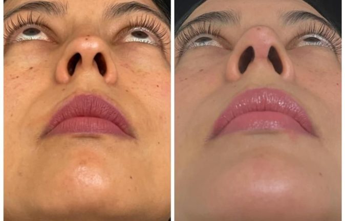 Rinoplastia Caso 41 Antes - Después 2