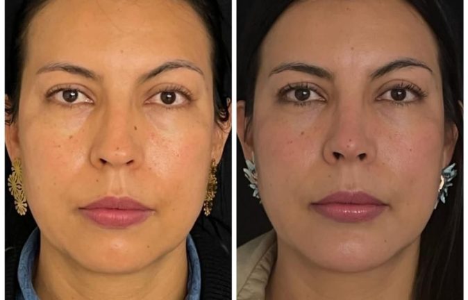 Rinoplastia Caso 42 Antes - Después