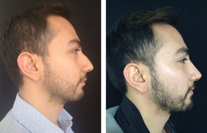 Rinoplastia Hombre