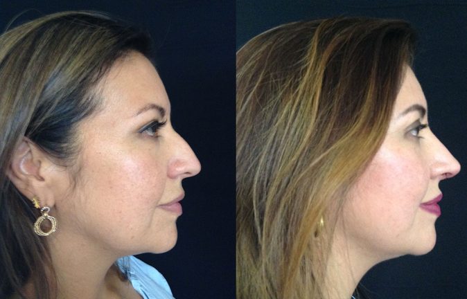 Rinoplastia Testimonios