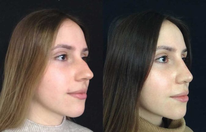 Rinoplastia antes y despues