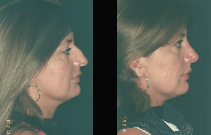 Rinoplastia cirugia