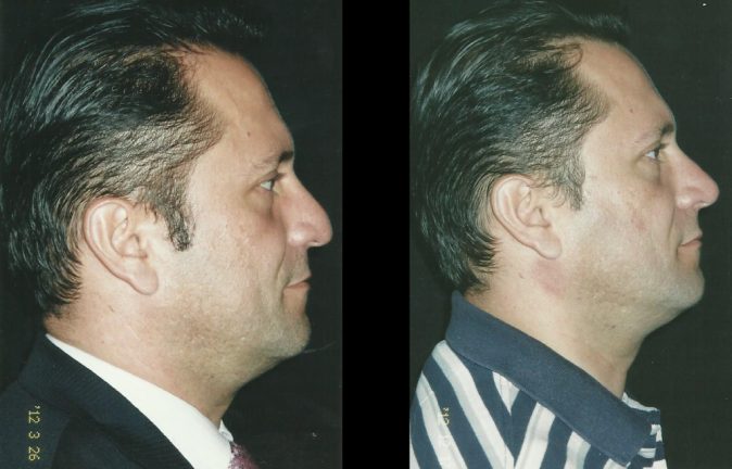 Rinoplastias Testimonios