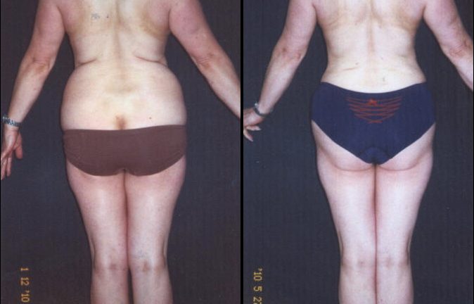 abdominoplastia