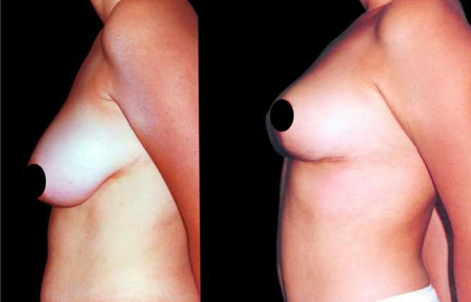 cirugia elevacion de senos en Colombia